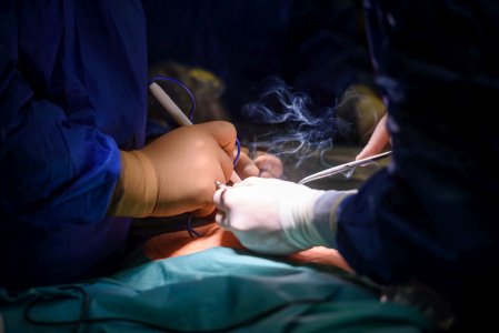 operacja-laparoskopii18